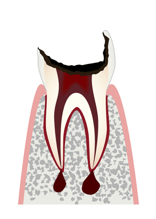 歯根まで進行したむし歯