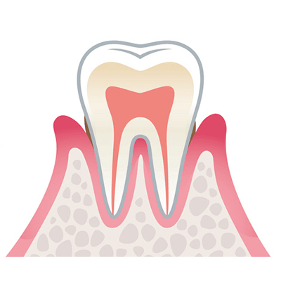 軽度歯周病（P1）