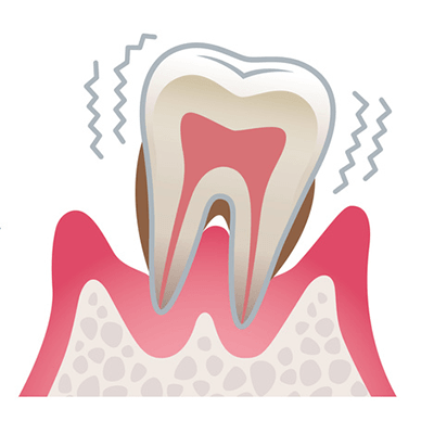 重度歯周病（P3）